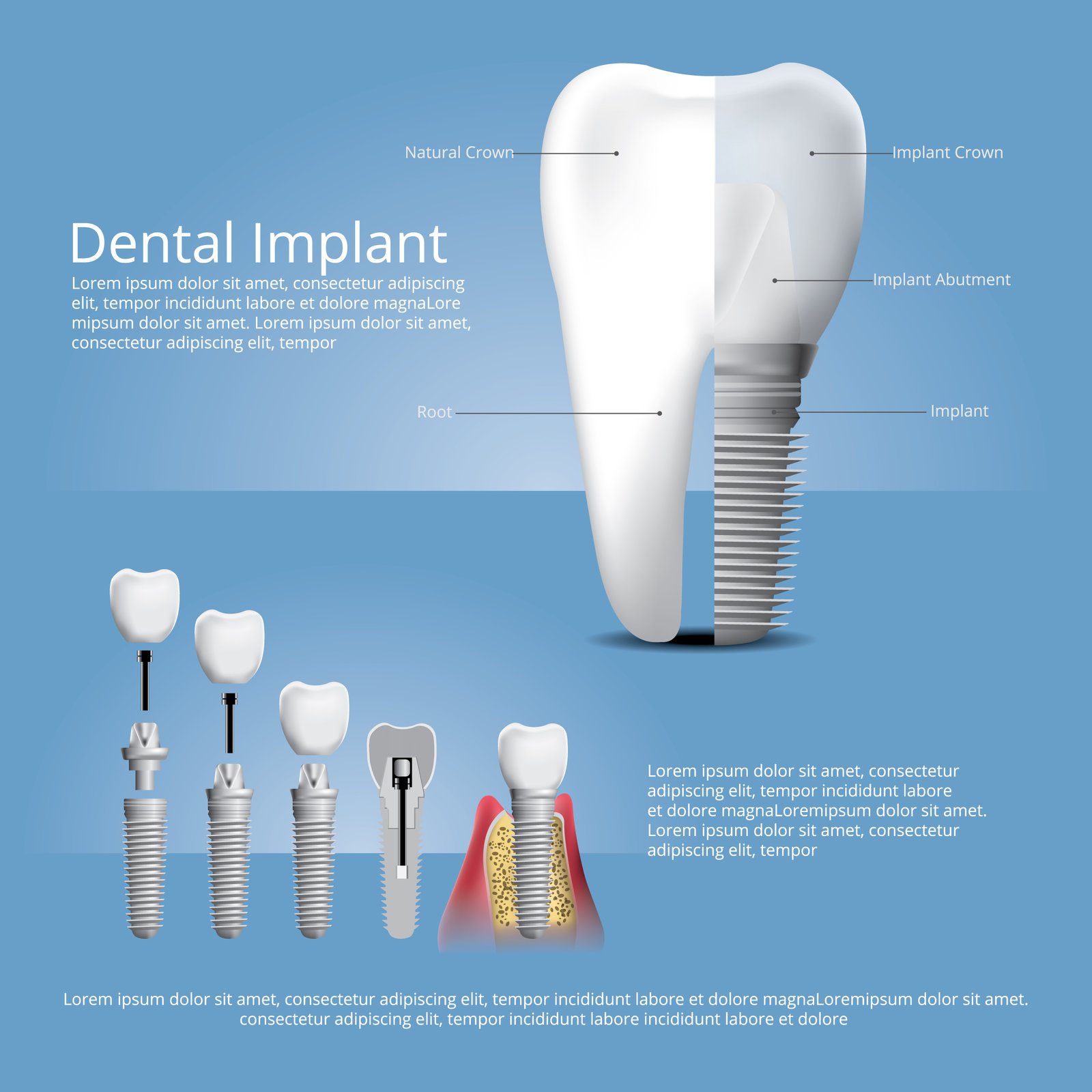 What to Expect During a Dental Implant Procedure