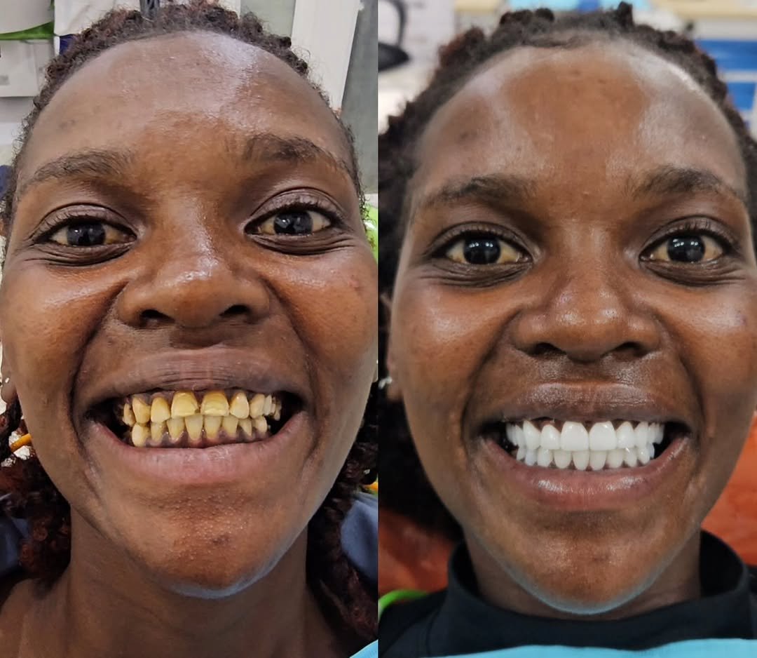 Dental Crowns