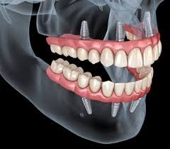 All-on-4 Restorations