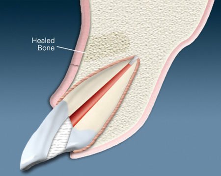 Root-End Surgery