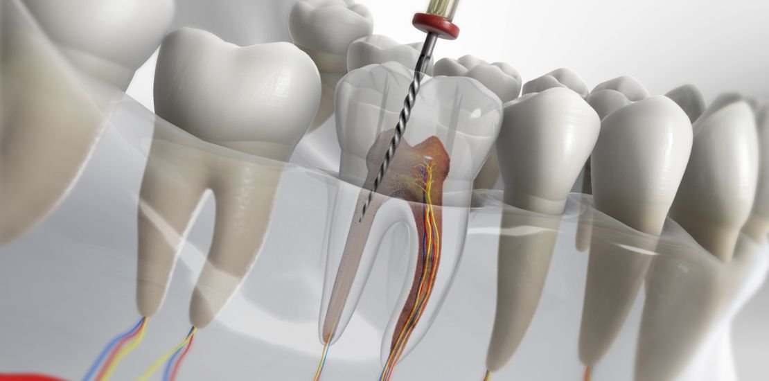 Single Canal Root Canal