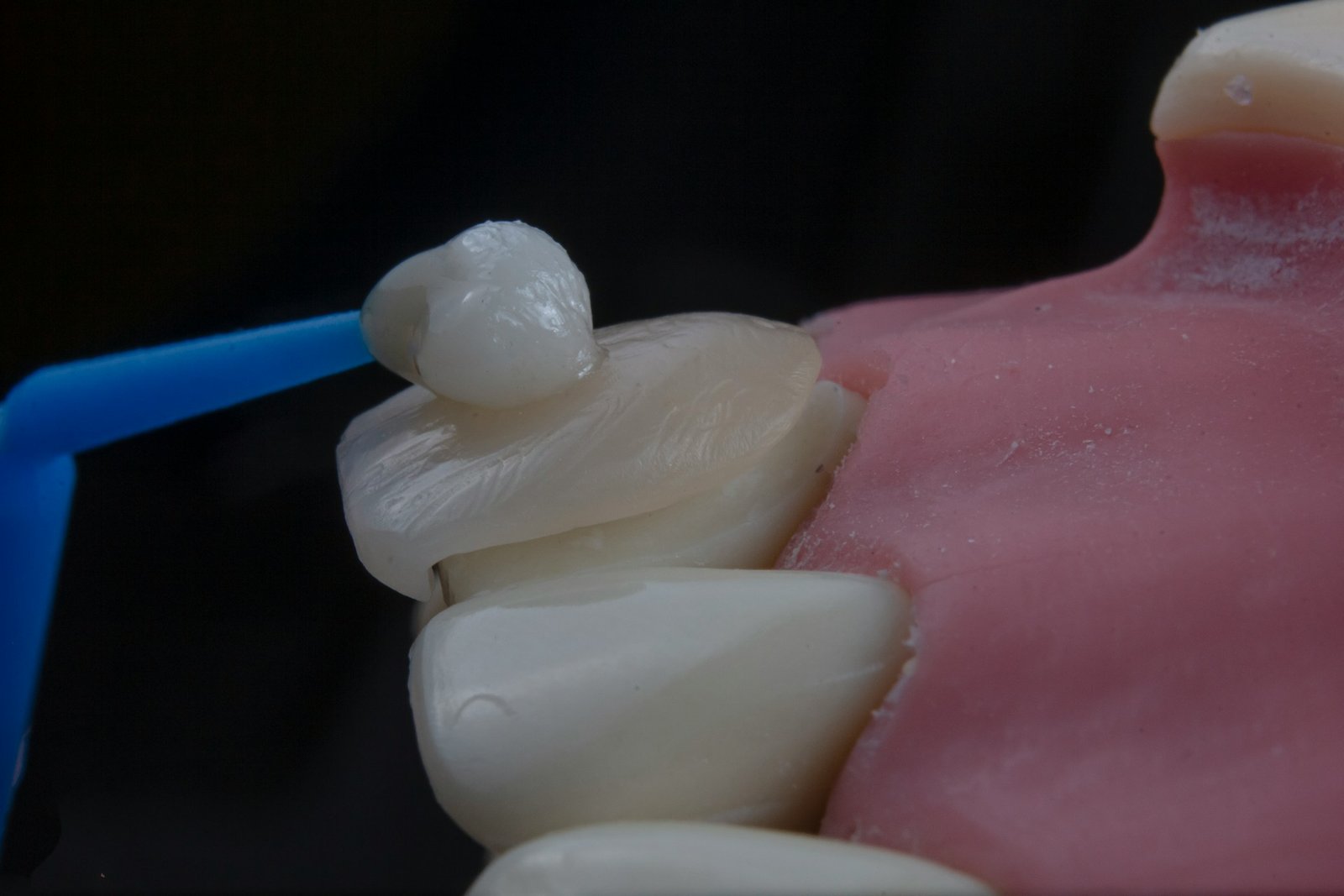 Lost Filling Replacement