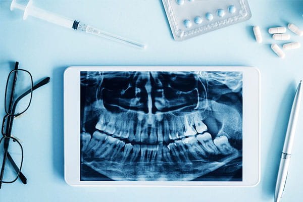 Panoramic X-Rays