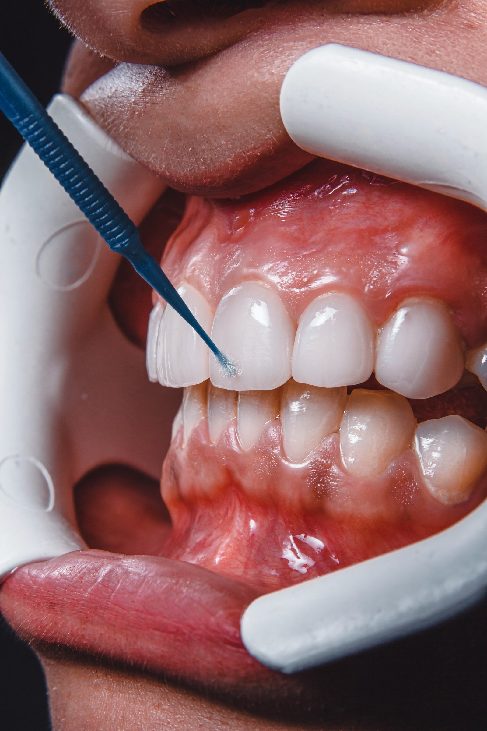 Temporary Fillings