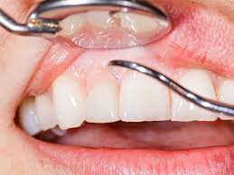Biopsies
