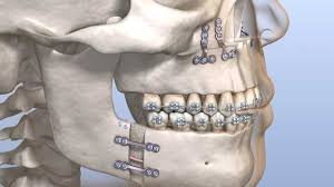 Orthognathic Surgery