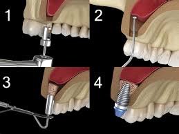 Sinus Lift Surgery