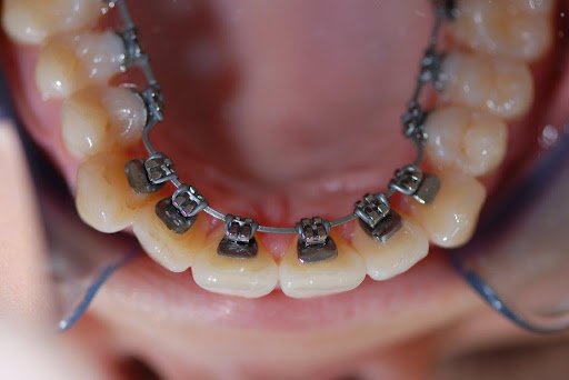 Lingual Braces