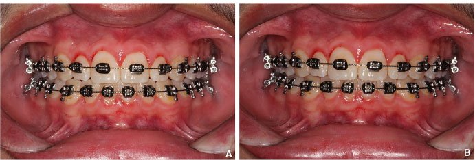 Orthodontic Adjustments