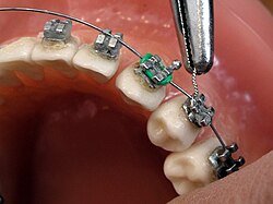 Orthodontic Repairs