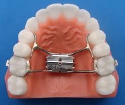 Palatal Expanders